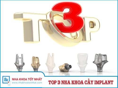 Top 3 Nha Khoa Cấy Implant Tại Hà Nội -1