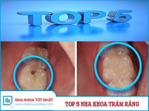 Top 5 Nha Khoa Trám Răng Tại Hà nội -1