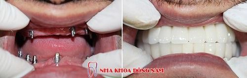 Trồng Răng Implant Ở Đâu Là Tốt Nhất -2