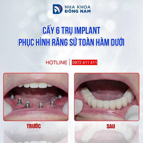 cấy ghép Implant tại nha khoa Đông Nam