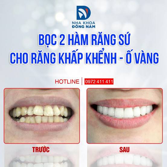 bọc răng sứ Emax tại nha khoa Đông Nam