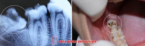 Giảm Giá 50% Nhổ Răng Nhân Dịp Noel 2016 -5