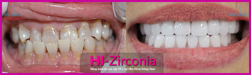 khuyen-mai-20%-rang-su-hi-zirconia-3