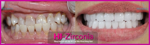 Giảm Ngay 20% Răng Sứ Cao Cấp Hi-Zirconia -2