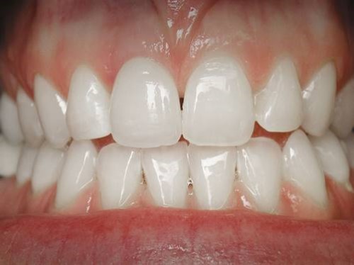 Chịu trống răng 1 tháng để kiếm tiền Trồng Implant 2