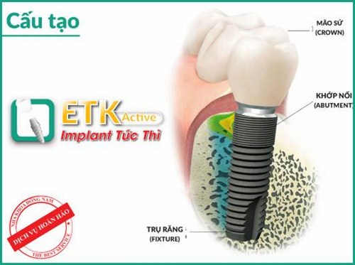 ƯU ĐÃI GIẢM 20% CHI PHÍ CẤY GHÉP IMPLANT ETK ACTIVE -2