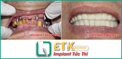 ƯU ĐÃI GIẢM 20% CHI PHÍ CẤY GHÉP IMPLANT ETK ACTIVE -4