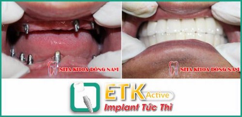 ƯU ĐÃI GIẢM 20% CHI PHÍ CẤY GHÉP IMPLANT ETK ACTIVE -5