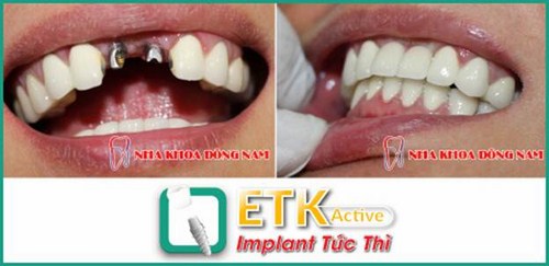 ƯU ĐÃI GIẢM 20% CHI PHÍ CẤY GHÉP IMPLANT ETK ACTIVE -6