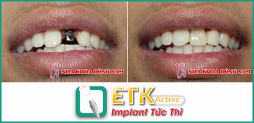 ƯU ĐÃI GIẢM 20% CHI PHÍ CẤY GHÉP IMPLANT ETK ACTIVE -6