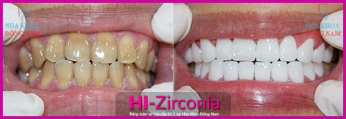 Giảm 20% Chi Phí Răng Sứ Cao Cấp HI-Zirconia Nhân Dịp 30/4 Và 1/5 -4