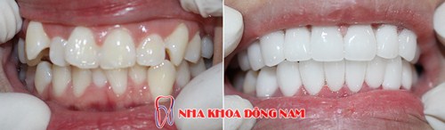 Giảm 20% Chi Phí Răng Sứ Cao Cấp HI-Zirconia Nhân Dịp 30/4 Và 1/5 -8