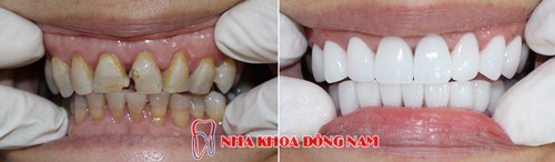 Giảm 20% Chi Phí Răng Sứ Cao Cấp HI-Zirconia Nhân Dịp 30/4 Và 1/5 -9