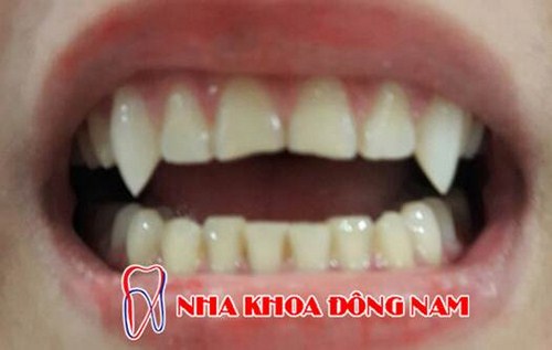 ƯU ĐÃI GIẢM 50% CHI PHÍ ĐẮP RĂNG NANH, RĂNG KHỂNH -5