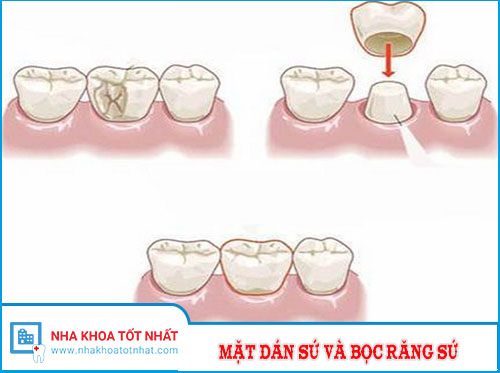 So Sánh Mặt Dán Sứ Và Bọc Răng Sứ