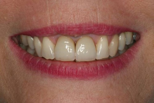 Nhổ Răng Và Trồng Răng Implant Trong Vòng 3 Tuần