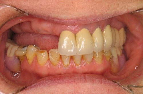 trồng răng implant tiết kiệm chi phí
