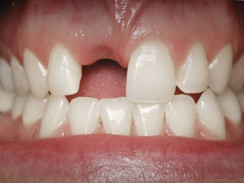 Chịu trống răng 1 tháng để kiếm tiền Trồng Implant