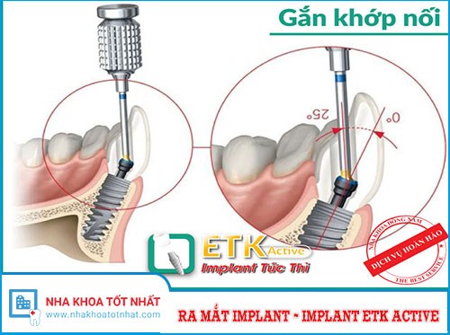 Nha Khoa Đông Nam Ưu Đãi 20% Cấy Ghép Implant ETK Active