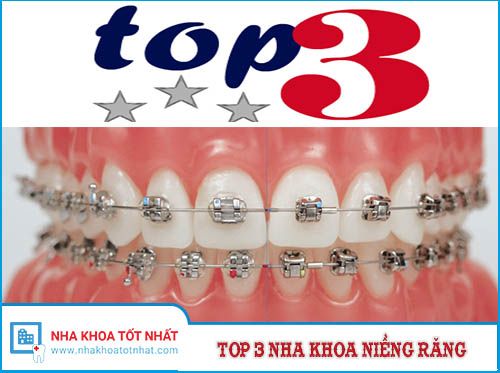 [REVIEW] Top 3 Nha Khoa Chỉnh Nha - Niềng Răng Tại Hà Nội