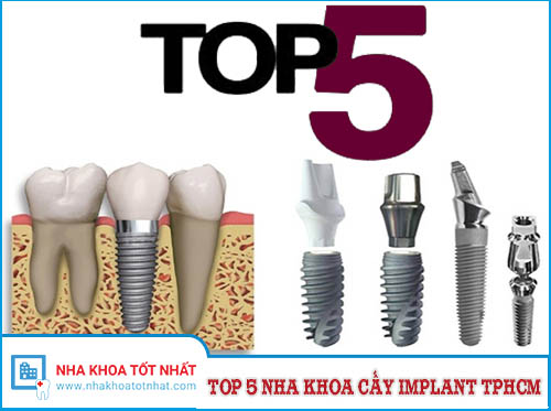 [REVIEW] Top 5 Nha Khoa Cấy Implant Tại TPHCM