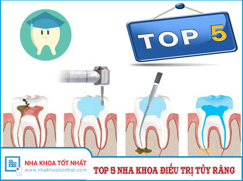 [REVIEW] Top 5 Nha Khoa Điều Trị Tủy Răng Tại TPHCM